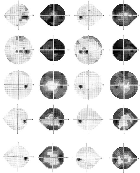 automated perimetry test results interpretation|Essentials of Automated Perimetry .